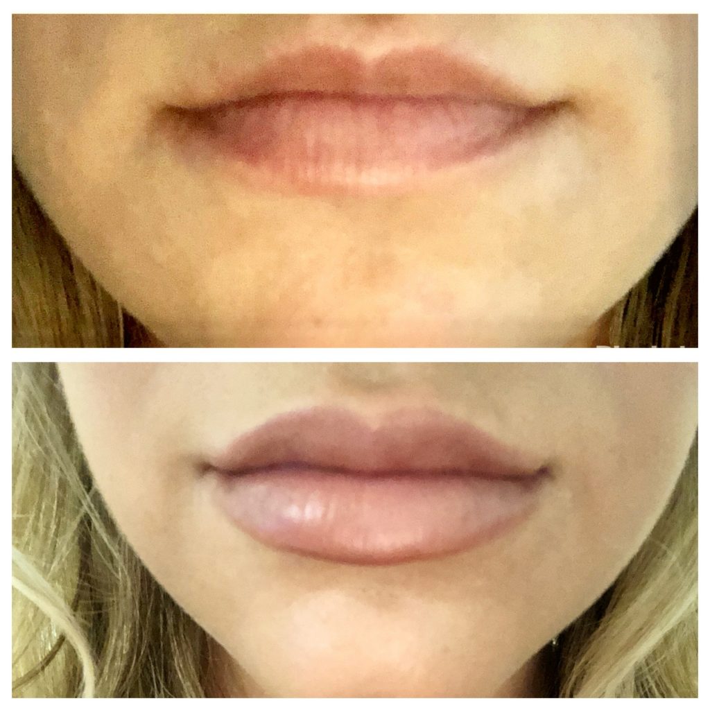 Revanesse Versa | Lip Injections | Fayetteville, NC | Élan Med Spa