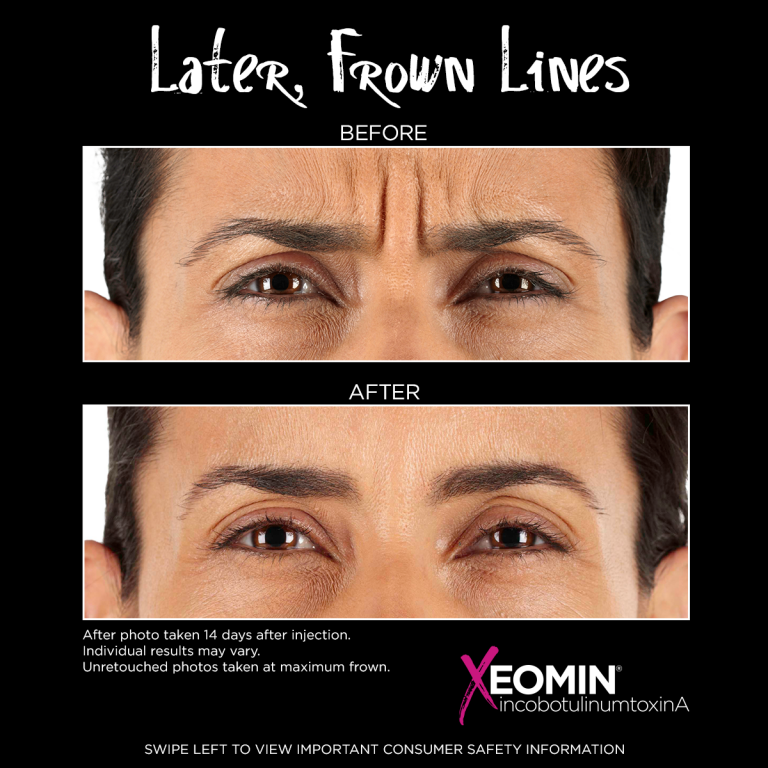 Xeomin Injections | Fayetteville, NC | Élan Med Spa